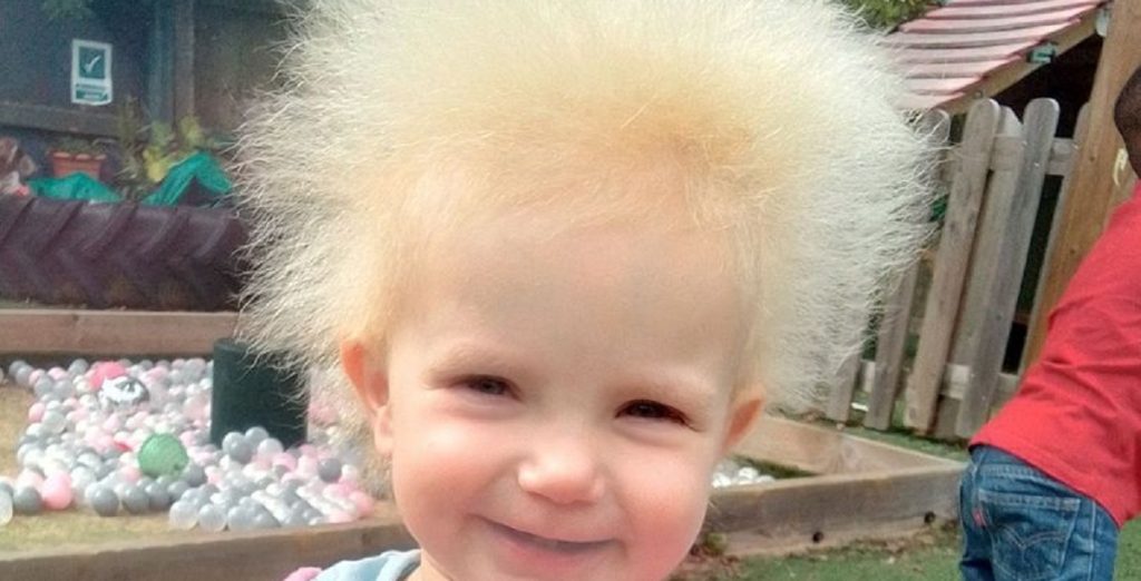 Pige med unikt hår fik usædvanlig diagnose: Nu tager hun nettet med storm