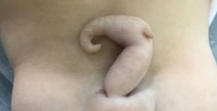 Læger fik et chok for livet: Pige blev født med 6 cm lang ‘hale’