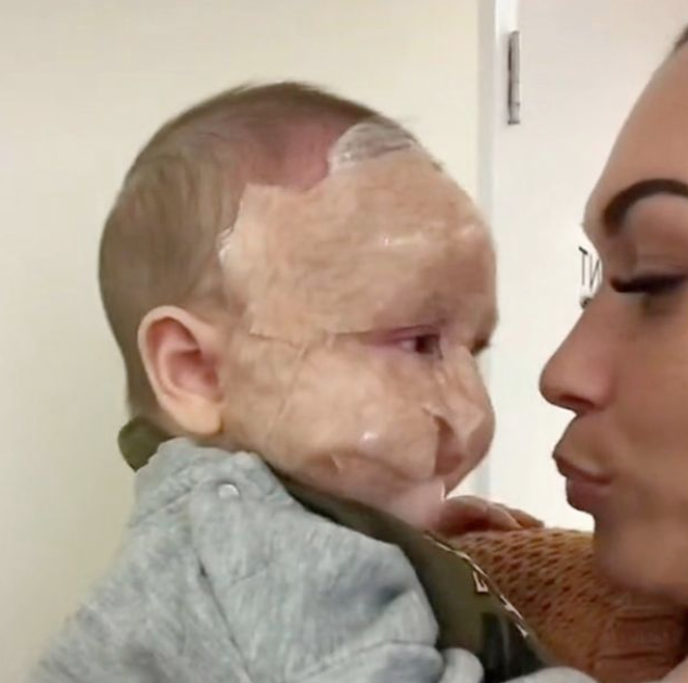 Mor fjernede babys modermærke med laser: Nu bliver hun lagt for had