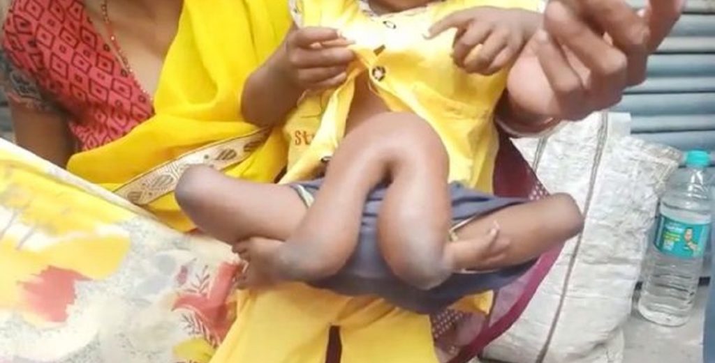 ‘Spider-Girl’ efterlod familien i chok: Født med fire ekstra lemmer