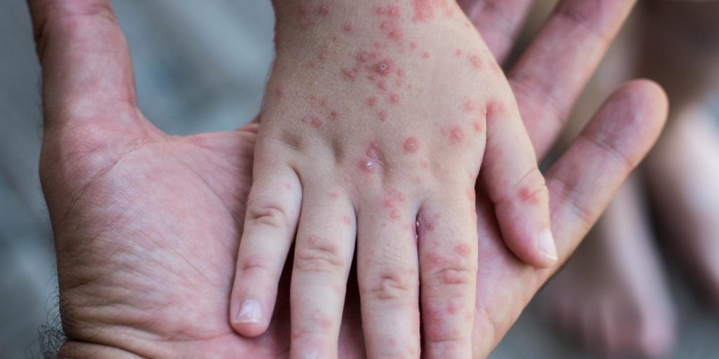 Første kvinde smittet med abekopper i Danmark