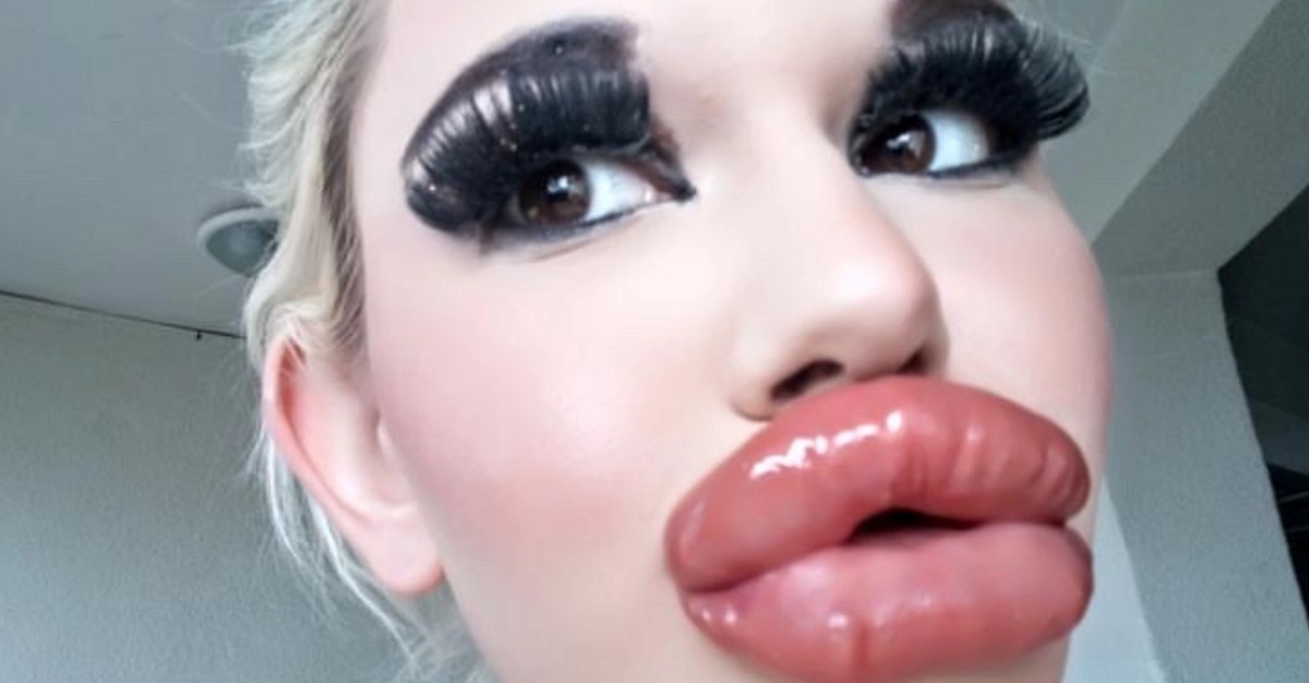 Kvinde med verdens største læber: Søger kæreste, men ikke “hvem som helst”