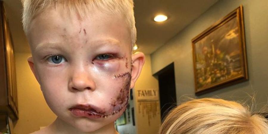 Lille pige angribes af bidsk hund – Så stiller storebror sig imellem