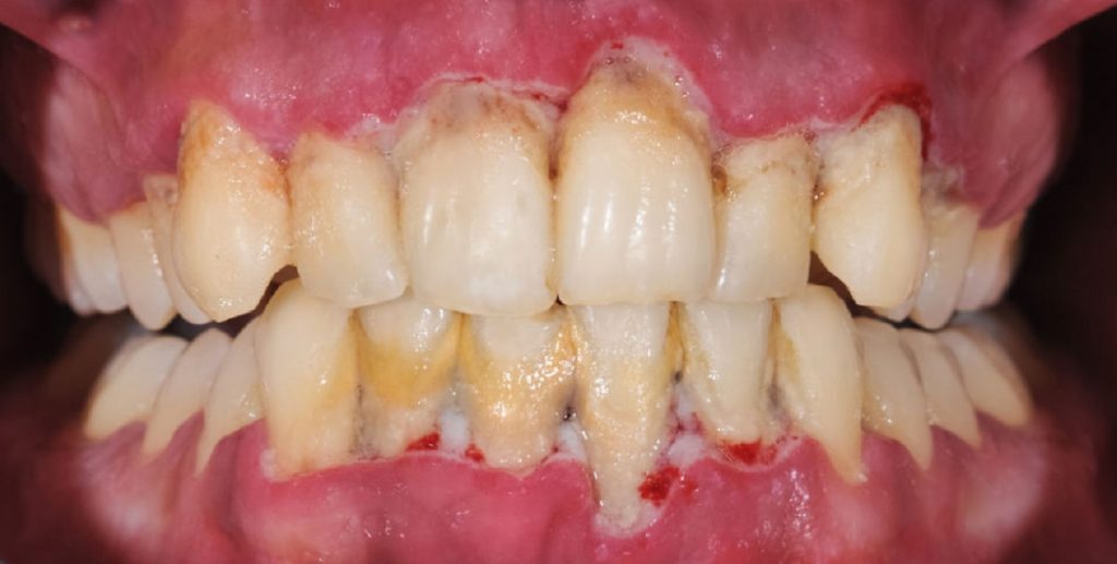 500 indlæggelser kan undgås: Dårlig mundhygiejne slår folk ihjel