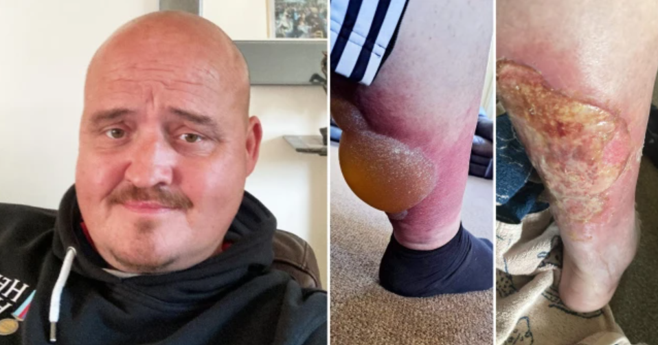 Far troede han var blevet stukket på en bar: Grunden var dog noget mere uhyggelig