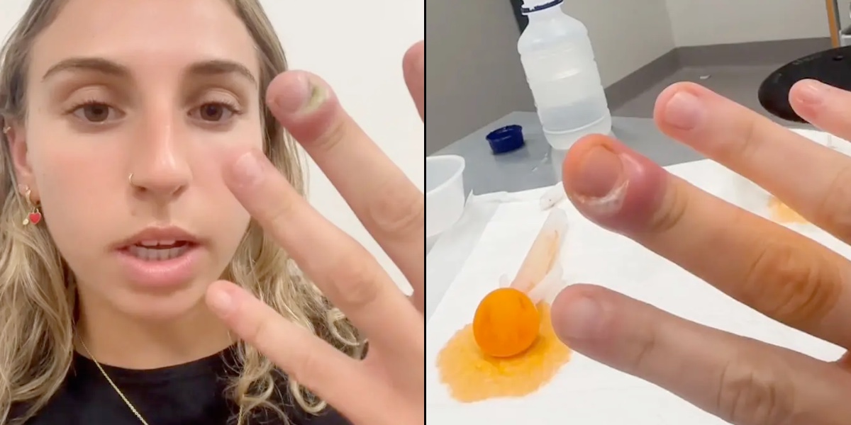 23-årig kvinde med vild afsløring: Sådan gjorde almindelig vane, at jeg endte på skadestuen