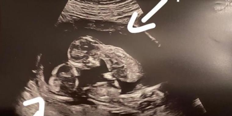 Var gravid med trillinger: Så opdagede lægerne en unik detalje