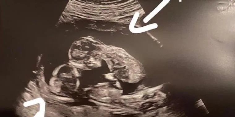 Var gravid med trillinger: Så opdagede lægerne en unik detalje