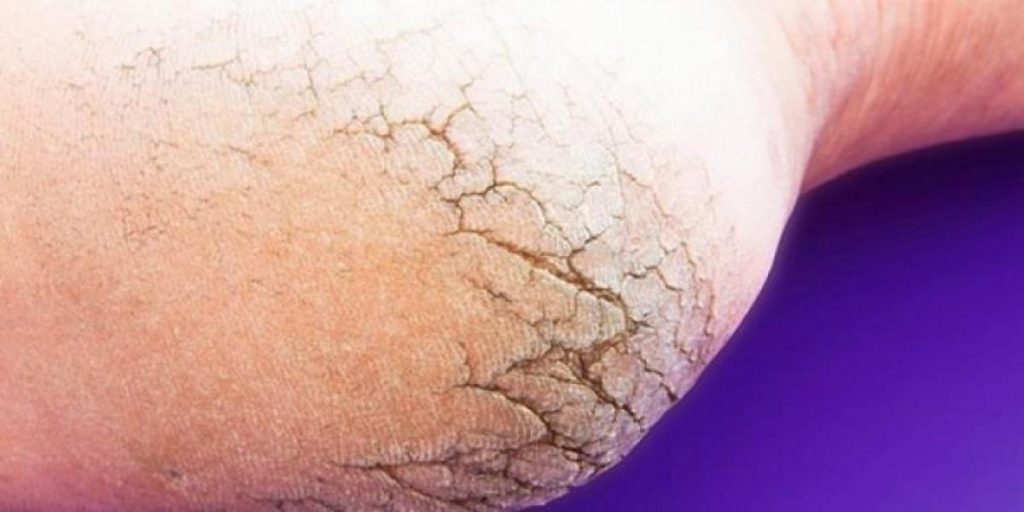 Ingen grund til at bruge penge på dyre produkter: Disse 2 ingredienser fra køkkenet vil redde dine fødder