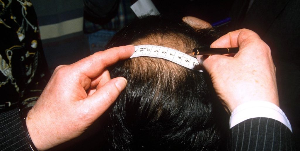 Høje tindinger eller måne? Flere mænd tyer til hårvitaminer: Men virker de?