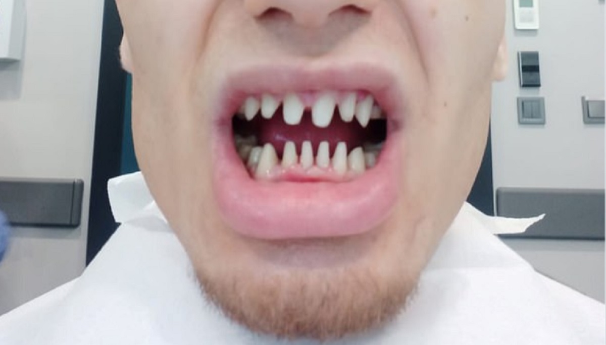 Fik tandbehandling i udlandet, men endte med at ligne “en haj”: Nu advarer han andre
