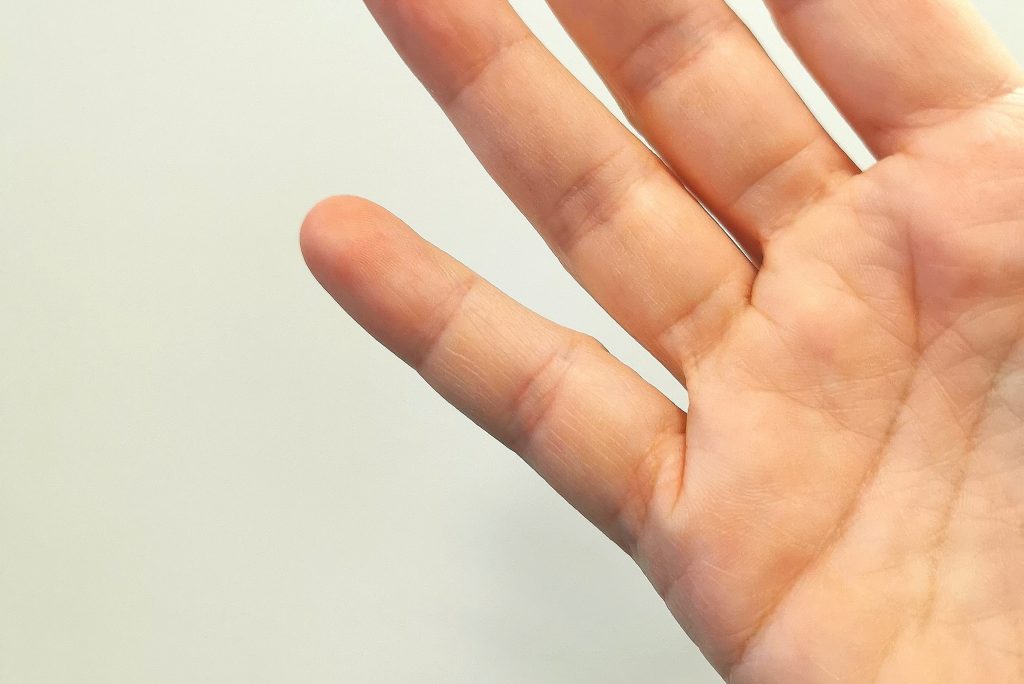 Din smartphone kan give permanent skade på din lillefinger: Mærk selv efter