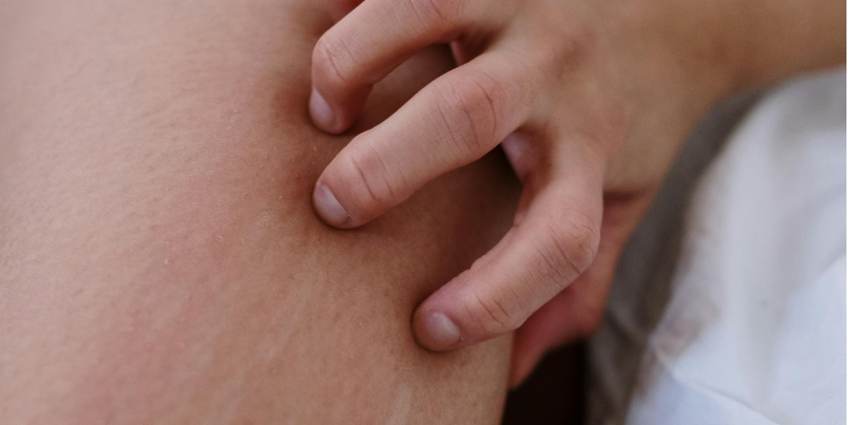 Gør det virkelig et kløende udslæt værre at klø sig? Nu har forskere endelig fundet svaret