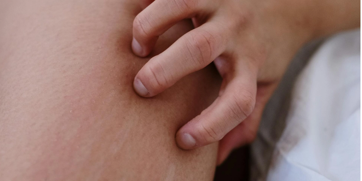 Gør det virkelig et kløende udslæt værre at klø sig? Nu har forskere endelig fundet svaret