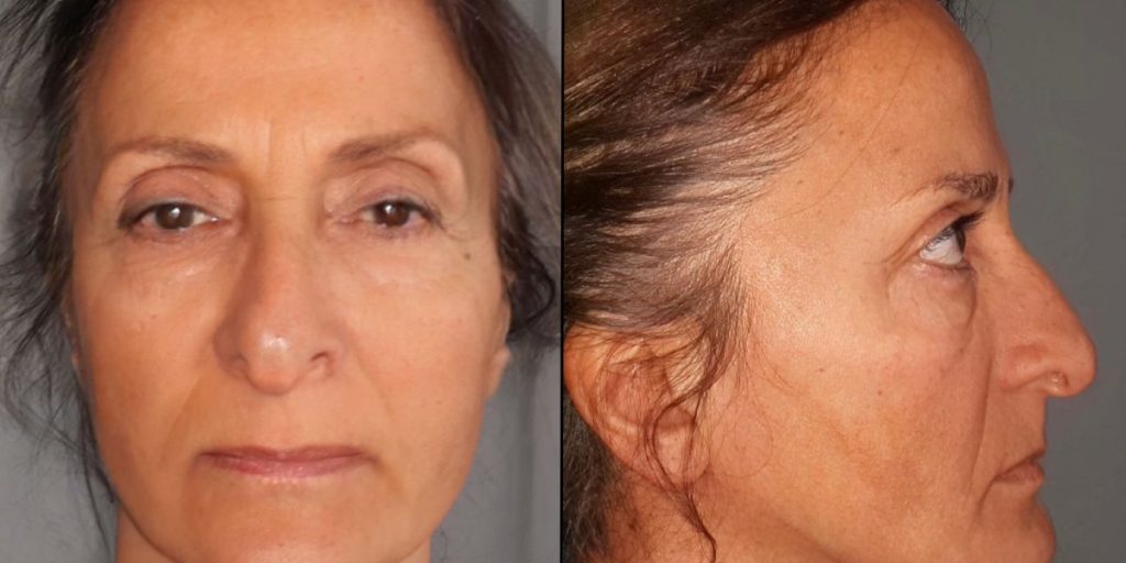 Kvinde gennemgår dramatisk plastikkirurgisk forvandling: Bagefter er hun fuldstændig ‘ukendelig’