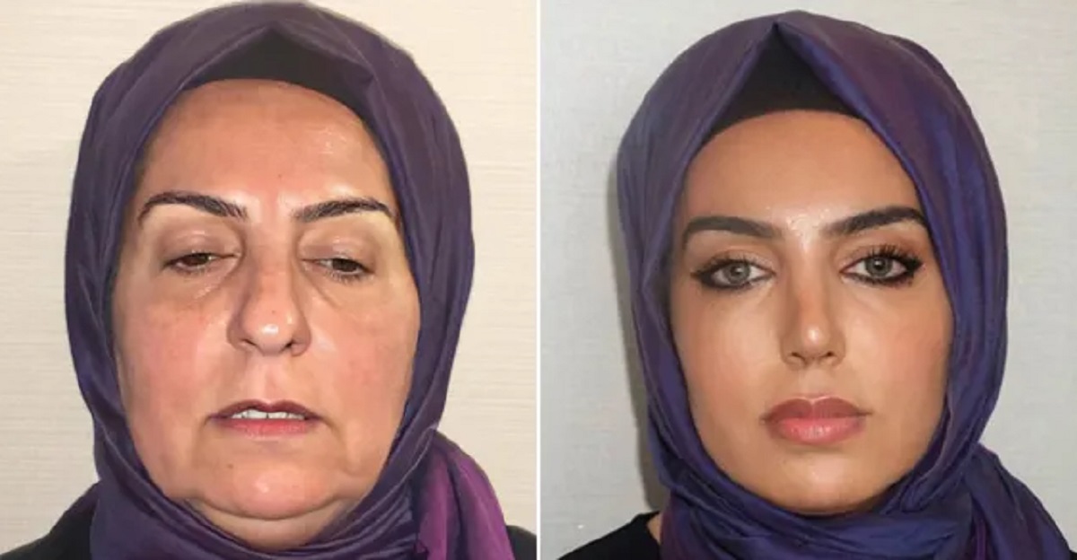 Før og efter-billeder fra klinik har chokeret internettet: ‘Hun ser 20 år yngre ud’