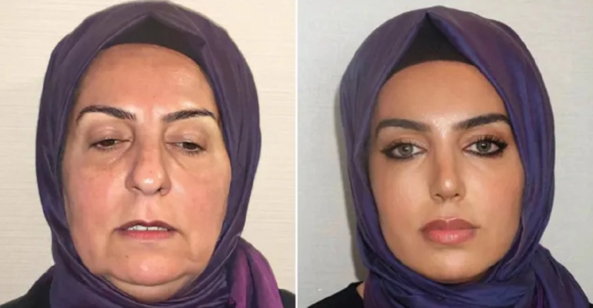 Før og efter-billeder fra klinik har chokeret internettet: ‘Hun ser 20 år yngre ud’