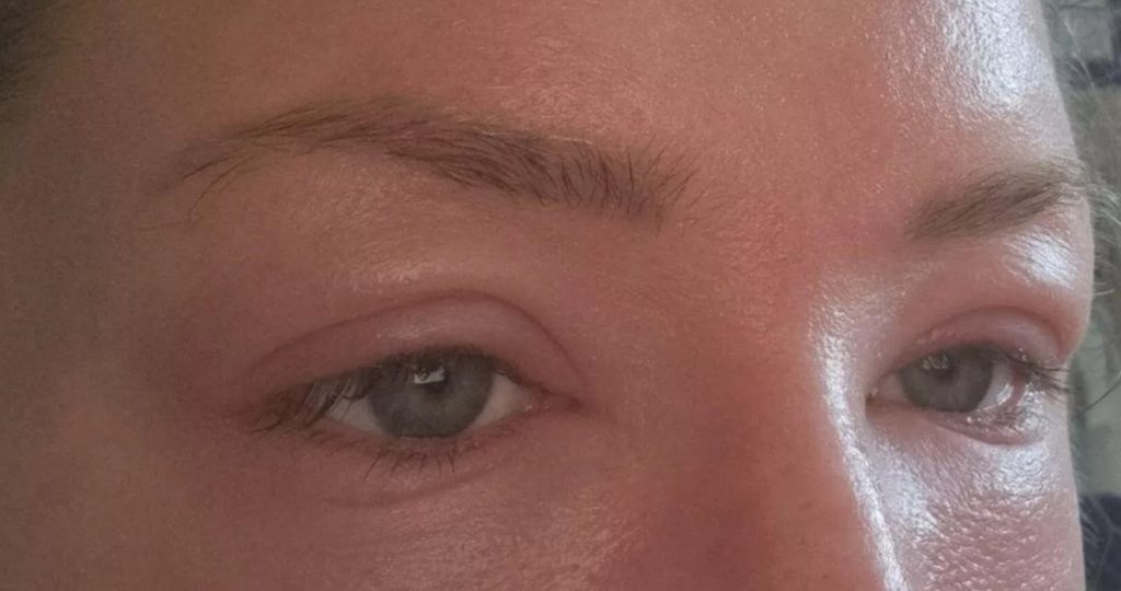 Hævede op efter at have fået lavet negle: Så fik hun en overraskende besked fra lægen