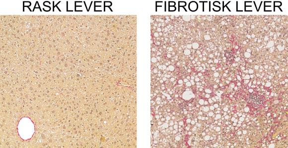 Nye opdagelser gør forskerne klogere på fibrosis og skrumpelever