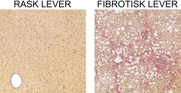 Nye opdagelser gør forskerne klogere på fibrosis og skrumpelever