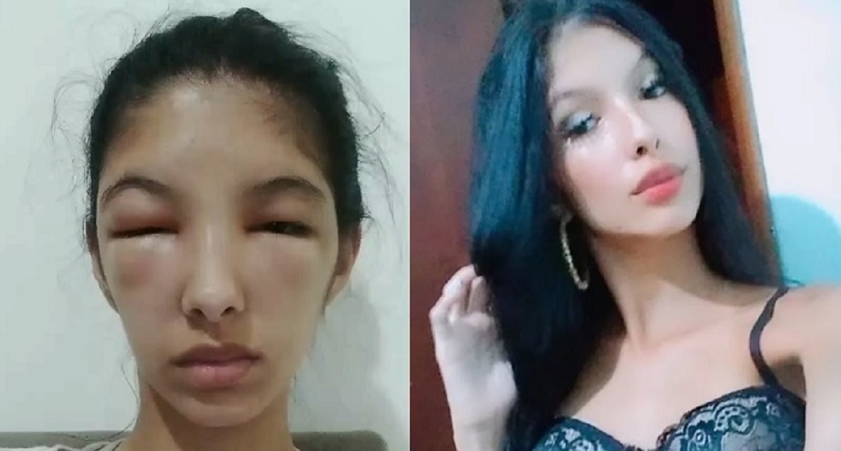 19-åriges hårfarvning gik HELT galt: Nu advarer hun andre