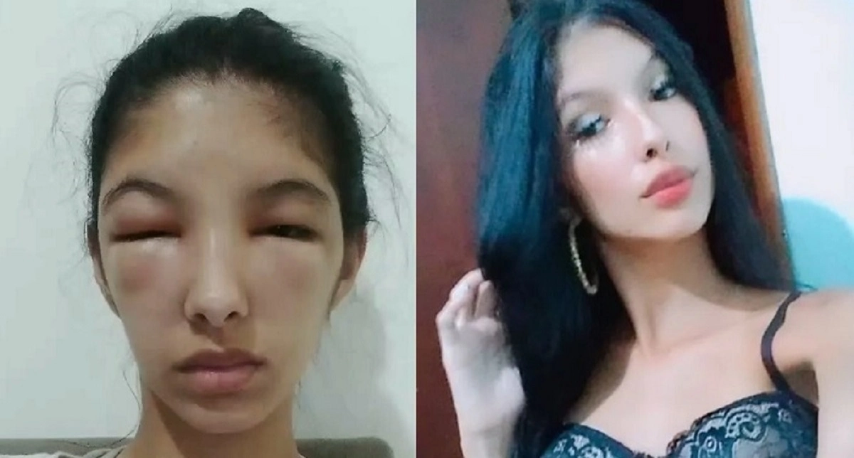 19-åriges hårfarvning gik HELT galt: Nu advarer hun andre