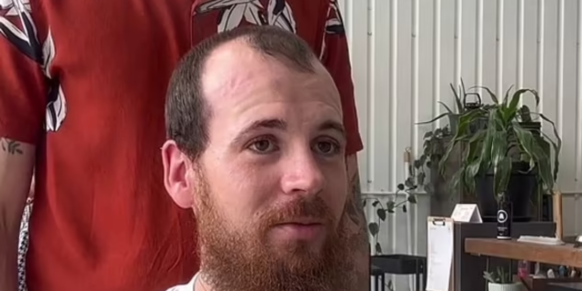 Mand havde lidt af hårtab i lang tid: Nu er han uigenkendelig efter ‘livsændrende’ transformation