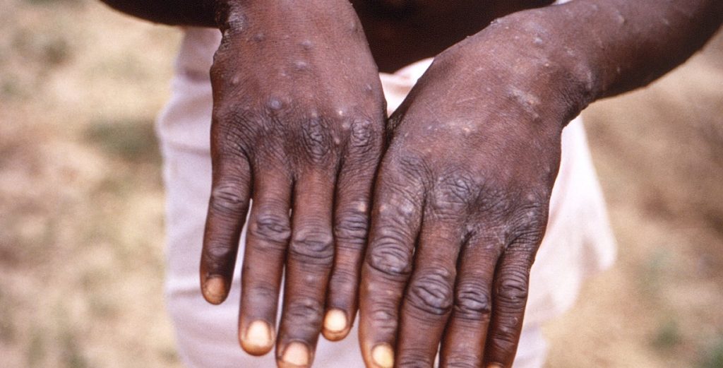 Nye bekymringer: Udbrud af monkeypox i Europa
