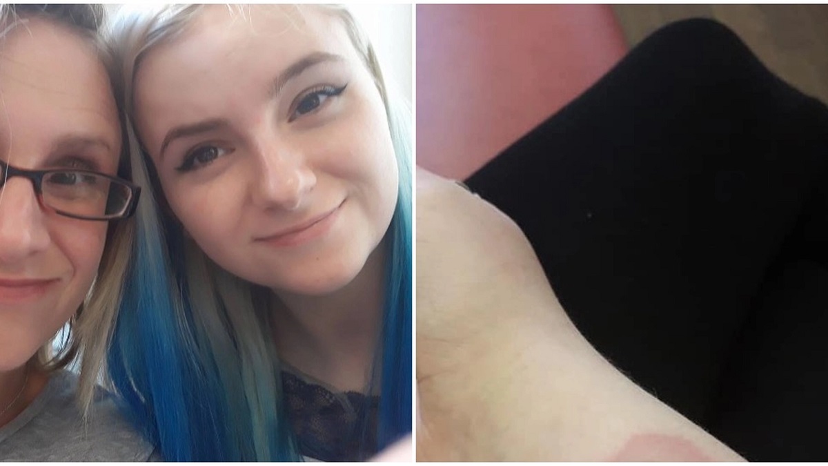 Mor deler billede af 10-årig datters arm som en advarsel til andre