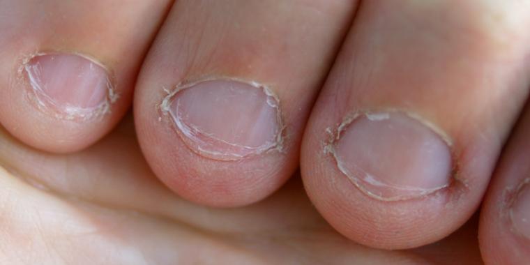 5 Ubehagelige fakta: Derfor skal du stoppe med at bide negle
