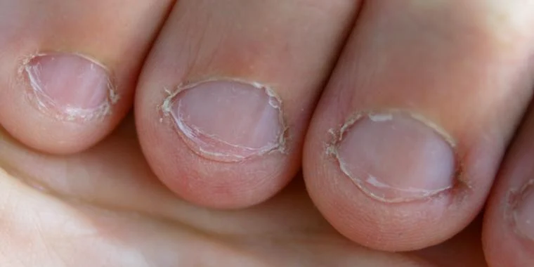 5 Ubehagelige fakta: Derfor skal du stoppe med at bide negle