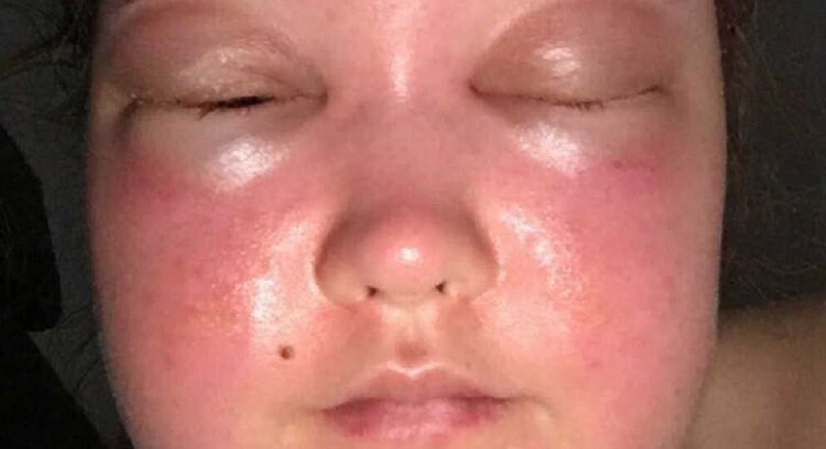 Efter ubehagelig oplevelse: Nu advarer 25-årig andre