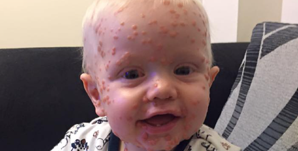 Daniel og Stephanie troede sønnen Oscar havde skoldkopper – men det var ikke sandheden