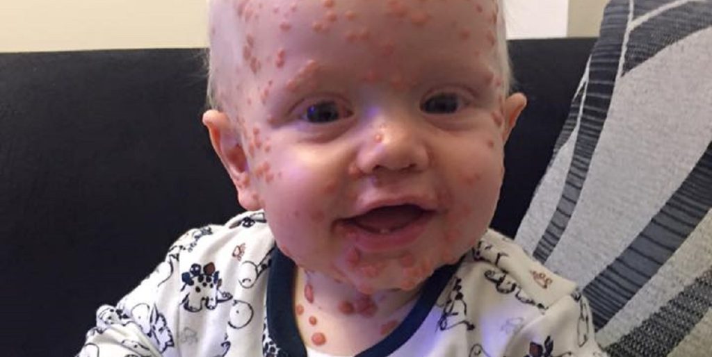 Troede Oscar havde fået skoldkopper: Viste sig at være langt værre