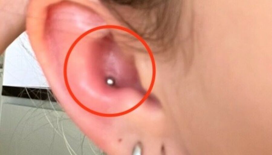 21-årig advarer efter piercing: – Den værste oplevelse nogensinde