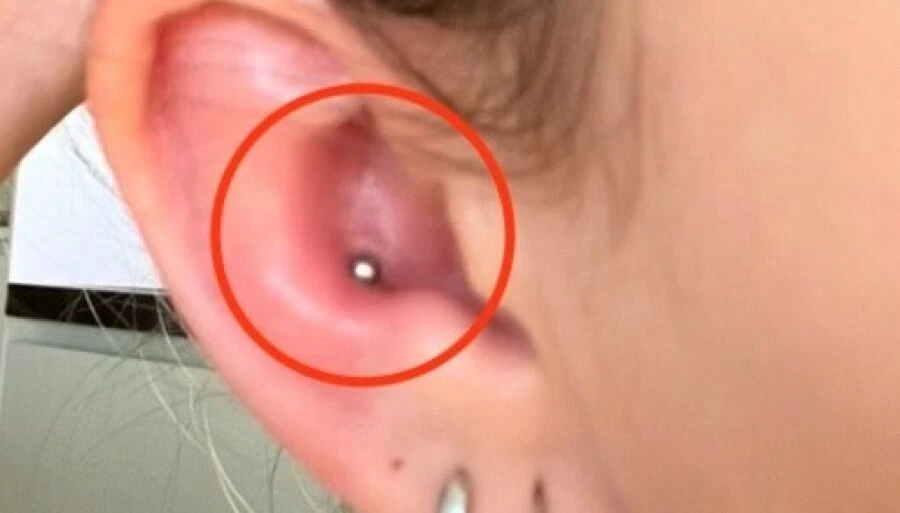 21-årig advarer efter piercing: – Den værste oplevelse nogensinde