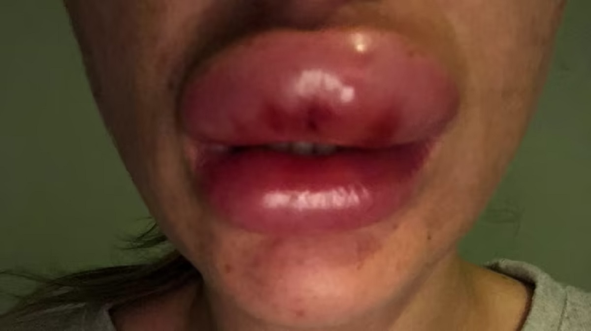 29-årig fik filler i læberne: Nu viser hun, hvor galt det kan gå
