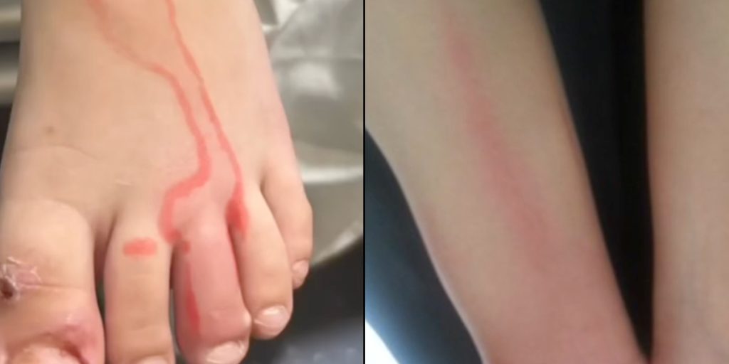 Læge deler advarsel: Denne røde linje på huden kan være tegn på ‘medicinsk nødsituation’