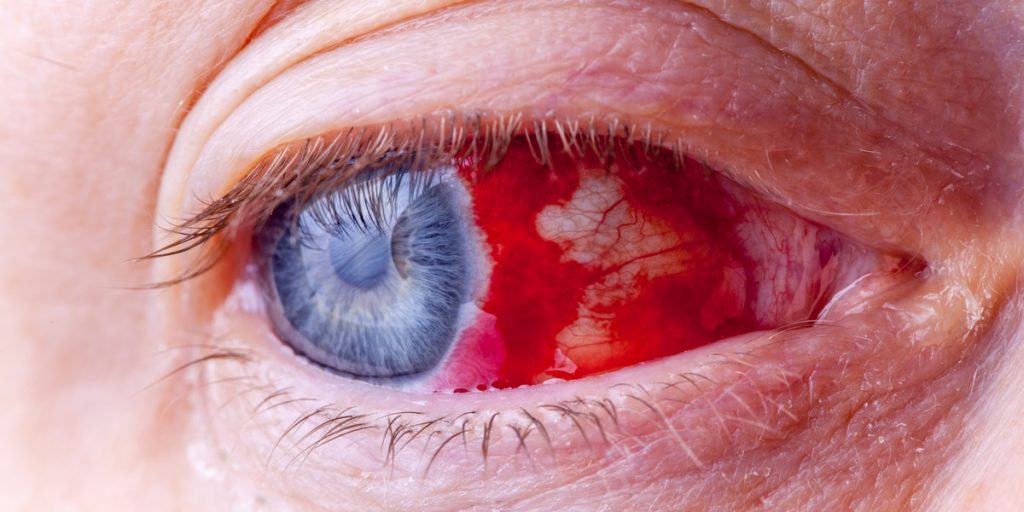 Viral virus: Dødelig øjenblødningsvirus fundet i Spanien