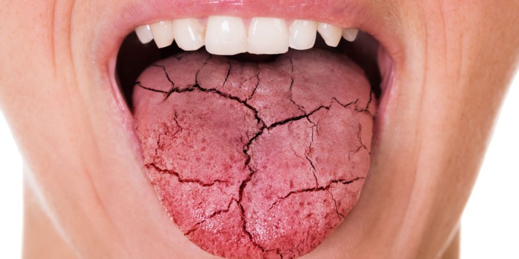 Vidste du det? Mundtørhed kan være tegn på disse alvorlige sygdomme