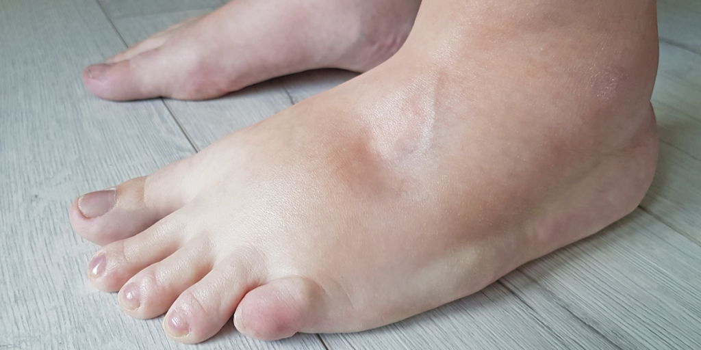 7 simple råd: Sådan slipper du af med hævede fødder og ankler