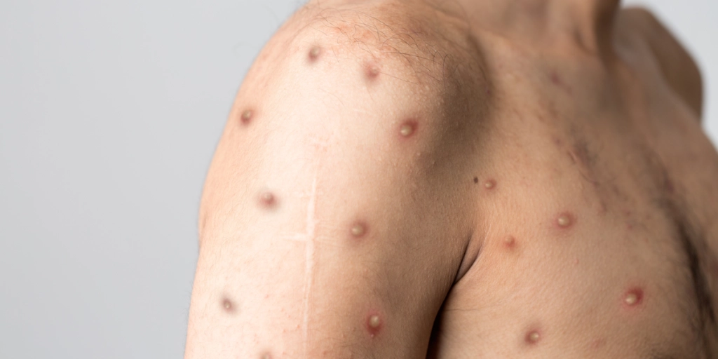 Så mange er vaccineret mod abekopper i Danmark