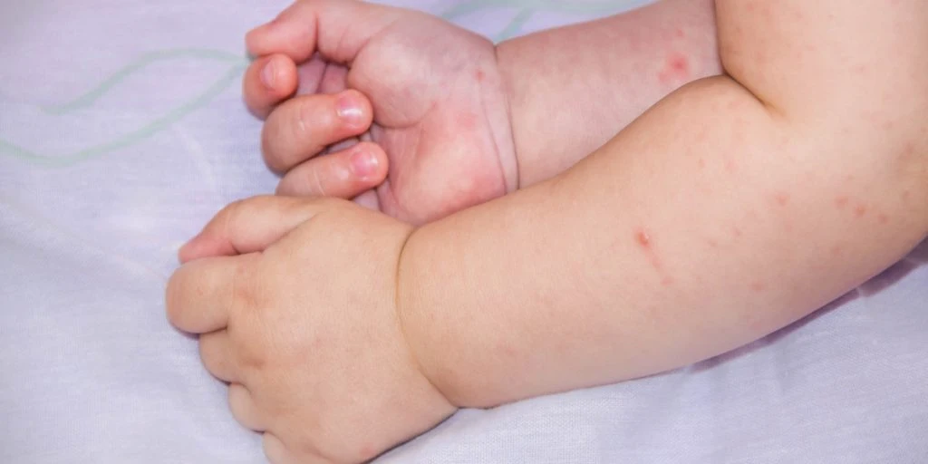 Jubler: Ældgammelt råd hjalp på plaget babys hudproblemer