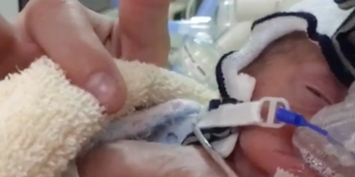 ‘Mirakelbaby’ vejede kun 350 gram ved fødslen: Sådan ser hun ud i dag