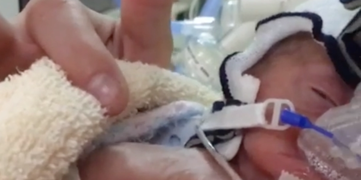‘Mirakelbaby’ vejede kun 350 gram ved fødslen: Sådan ser hun ud i dag