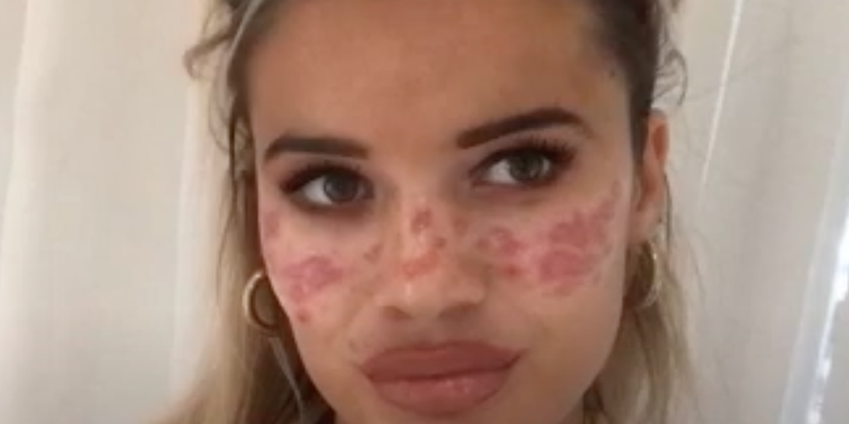 Kvinde prøvede TikTok-trend for at lave fregner: Nu vækker resultatet rædsel