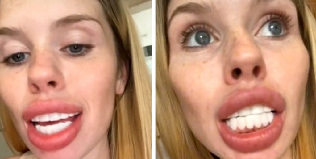 Folk er flade af grin over kvinde: Drømte om det perfekte smil, men endte med at ligne en hest