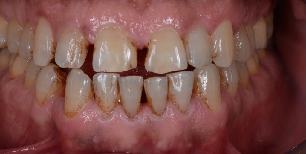 Tandlægeforeningen advarer: Kan give syreskader