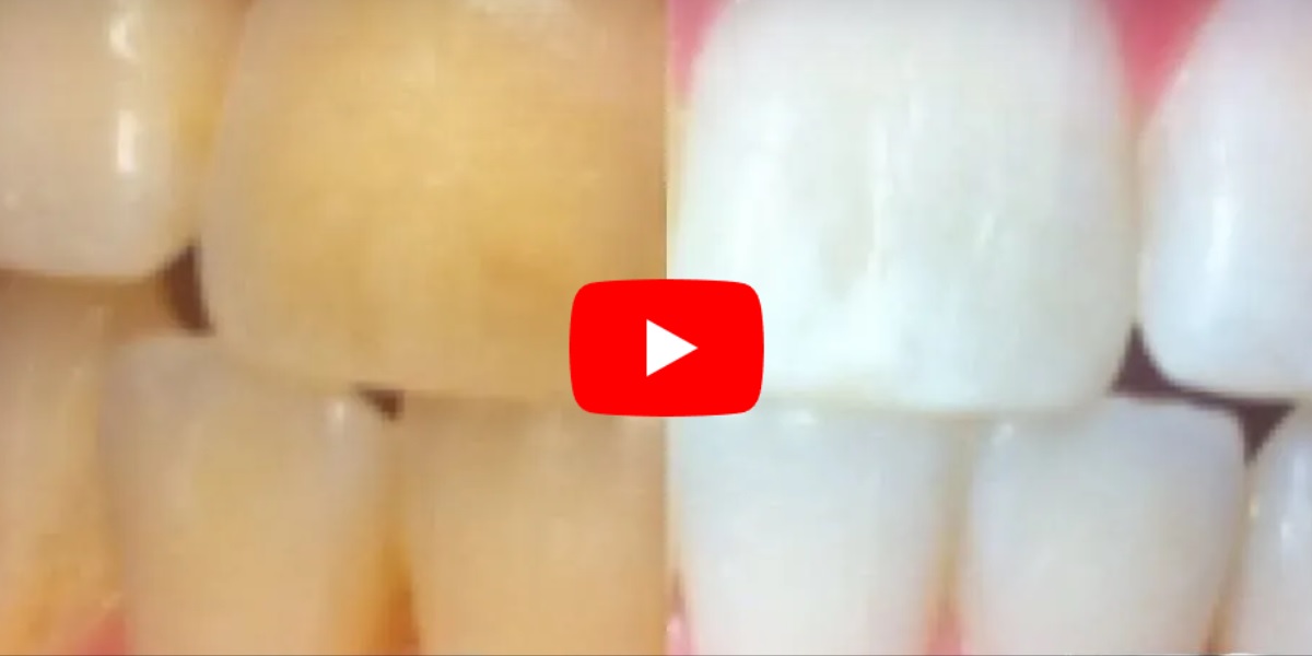 Nemt og billigt trick: Sådan får du HELT hvide tænder på 3 minutter