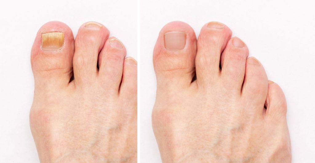 Få sunde og smukke negle til sommer – Slip af med gul tåneglsvamp